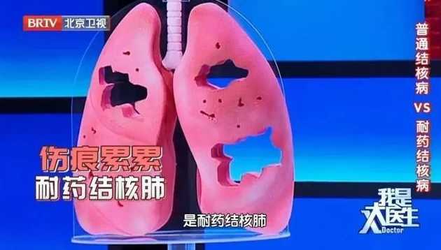 感染新冠病毒,哪些症状表明已入肺?